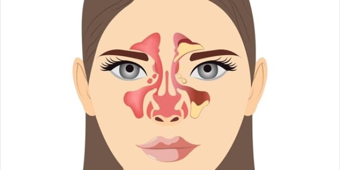 Ostre i Przewlekłe Zapalenie Zatok Przynosowych: Objawy, Metody Leczenia oraz Profilaktyka