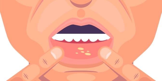 Opryszczka: Źródła, Objawy i Skuteczne Sposoby Leczenia